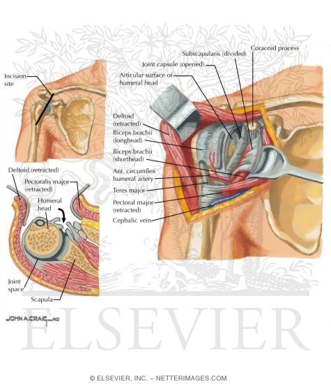 Deltopectoral Approach to Shoulder Joint
