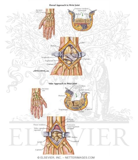 Watermarked preview of labeled image: Surgical Approaches to the Wrist