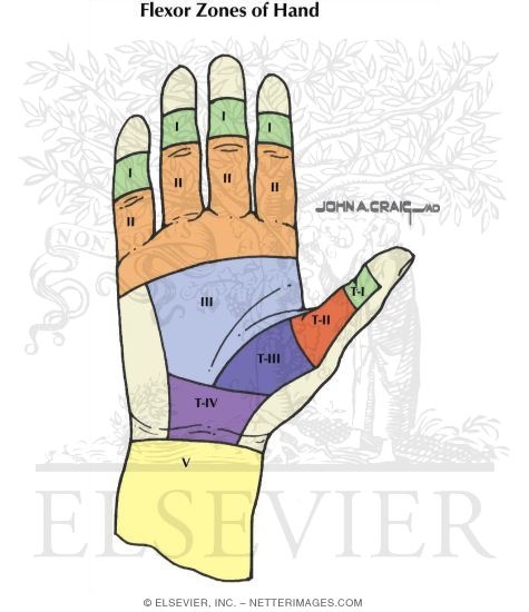 Flexor Tendon Injury Zones