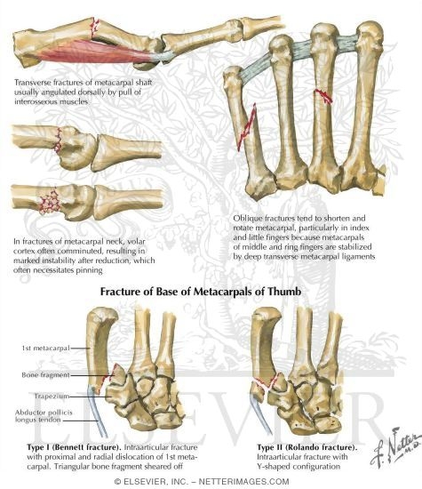 Metacarpal Fractures