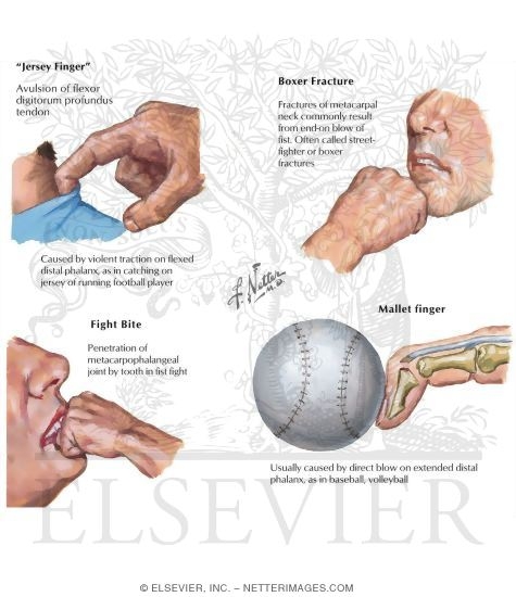 Jersey Finger
Boxer Fracture
Fight Bite
Mallet Finger