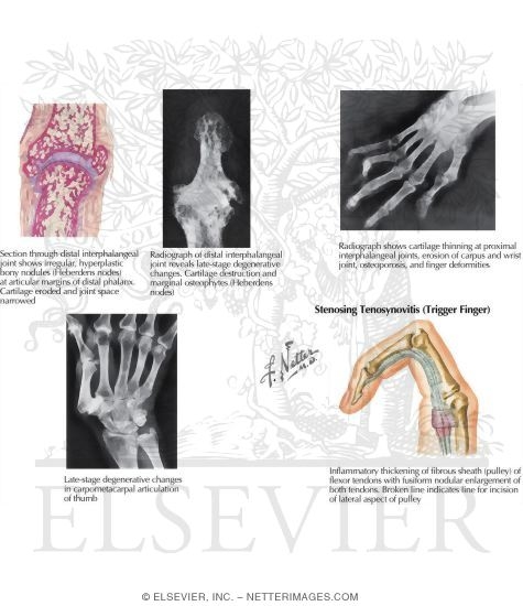 Watermarked preview of labeled image: Disorders: Arthritis