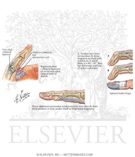 Watermarked preview of labeled image: Disorders: Ligament Injuries