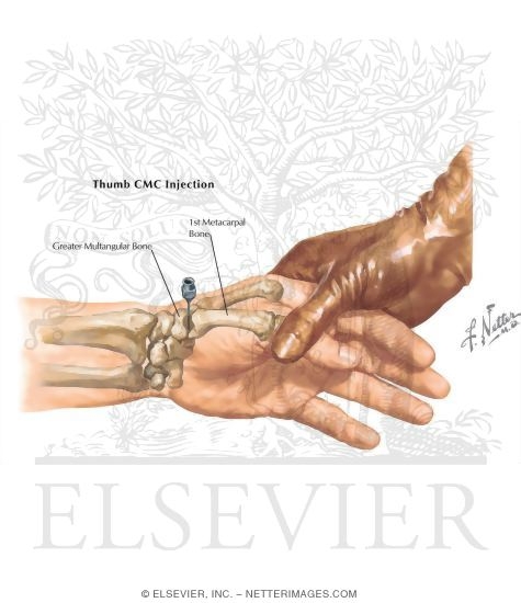 Watermarked preview of labeled image: Thumb CMC Injection