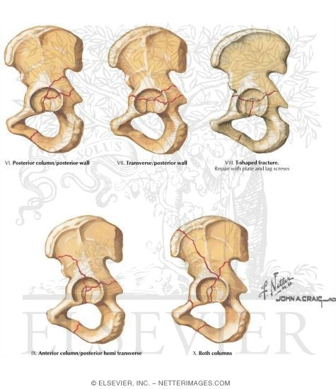 Watermarked preview of labeled image: Trauma of the Pelvis