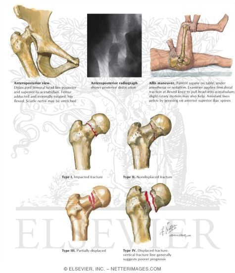 Watermarked preview of labeled image: Thigh and Hip Trauma