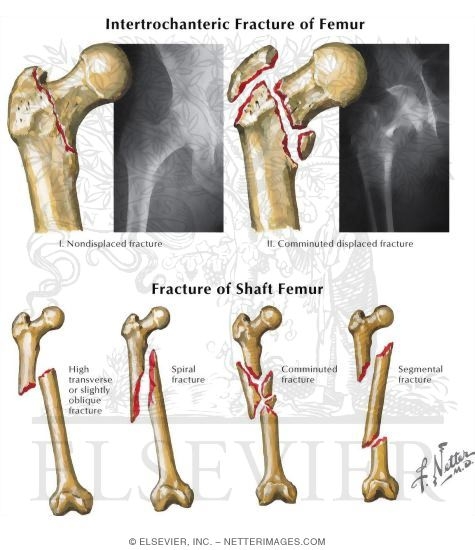 Thigh and Hip Trauma