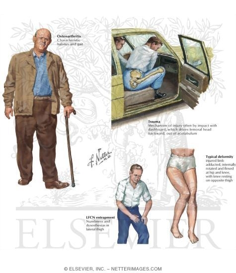 Watermarked preview of labeled image: History of Trauma to the Thigh and Hip