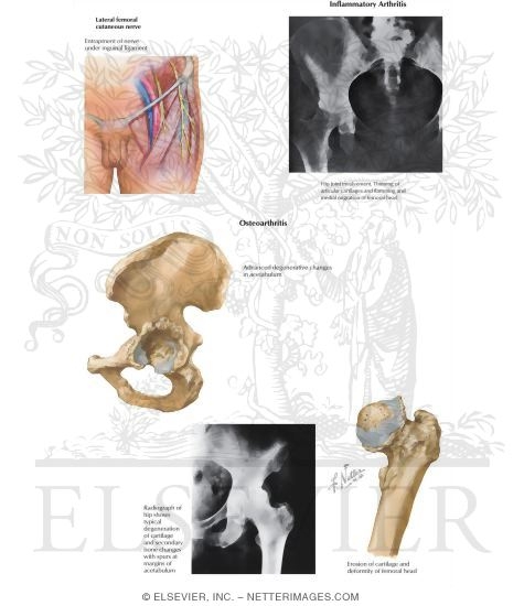 Watermarked preview of labeled image: Disorders of the Thigh and Hip