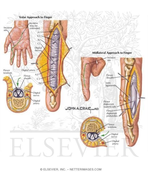 Watermarked preview of labeled image: Surgical Approach to Finger