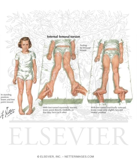Internal Femoral Torsion