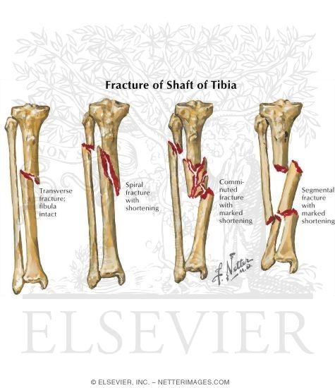 Fracture of Shaft of Tibia