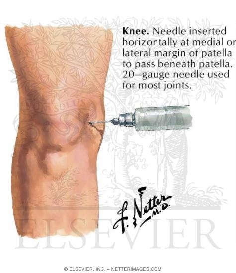 Watermarked preview of labeled image: Aspiration of Joint Fluid In the Knee
