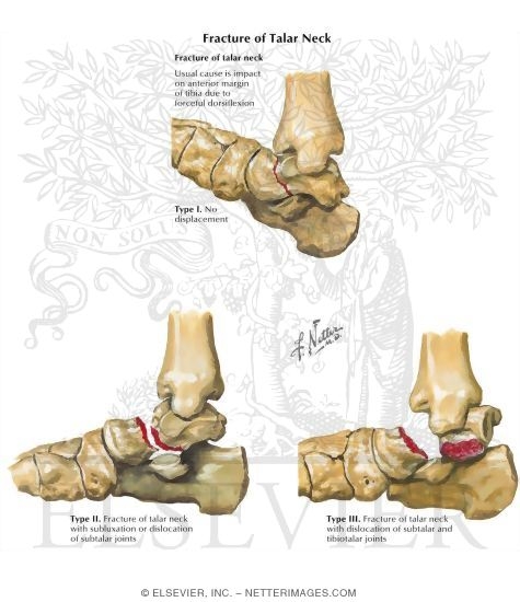 Watermarked preview of labeled image: Fracture of Talar Neck