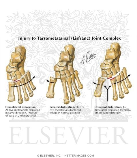 Injury to Tarsometatarsal (Lisfranc) Joint Complex