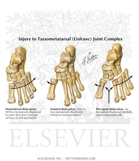 Watermarked preview of labeled image: Injury to Tarsometatarsal (Lisfranc) Joint Complex