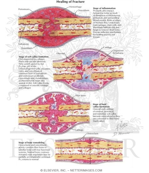 Watermarked preview of labeled image: Healing of Fracture