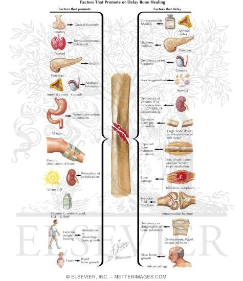 Watermarked preview of labeled image: Factors That Promote or Delay Bone Healing