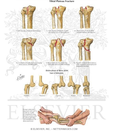 Trauma Of The Leg And Knee Tibial Plateau Fracture