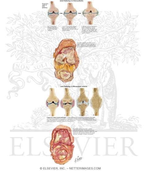 Joint Pathology in Osteoarthritis
Joint Pathology in Rheumatoid Arthritis
