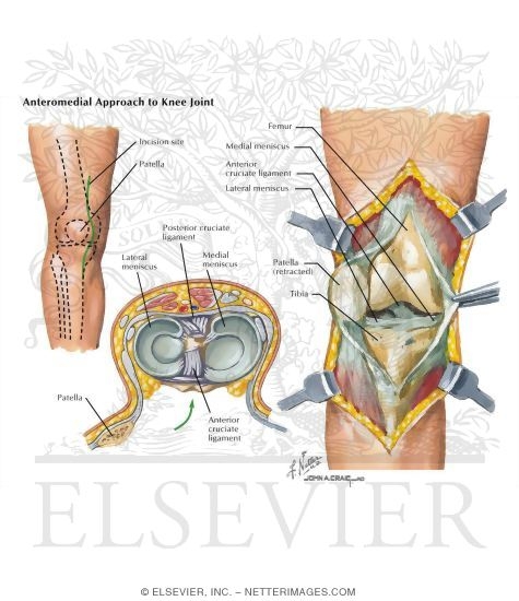 Watermarked preview of labeled image: Surgical Approaches to the Leg and Knee