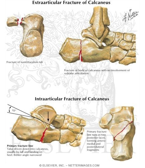 Extraarticular Fracture of Calcaneus
Intraarticular Fracture of Calcaneus