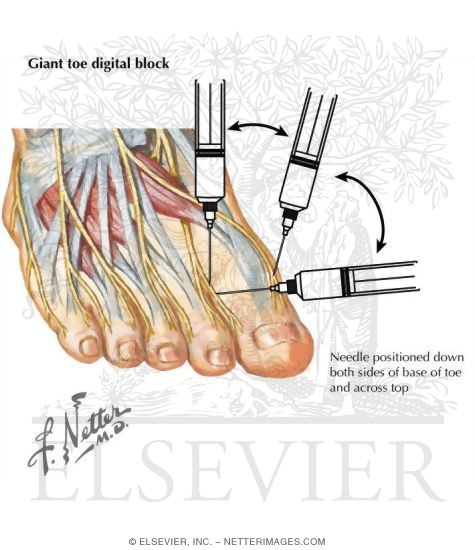 Ankle Arthrocentesis