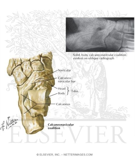 Watermarked preview of labeled image: Pediatric Disorders of the Foot
