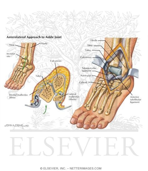 Watermarked preview of labeled image: Anterolateral Approach to the Ankle Joint
