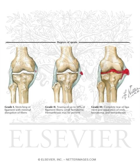 Degrees of Knee Sprain