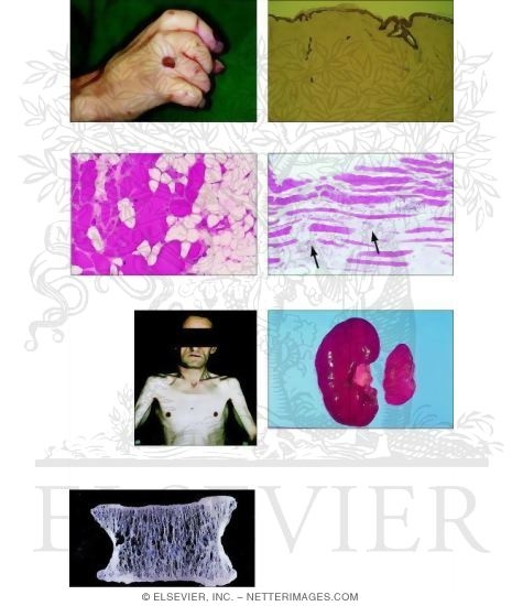 Watermarked preview of unlabeled image: General Reaction Patterns: Atrophy