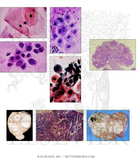 Dysplasia and Neoplasia