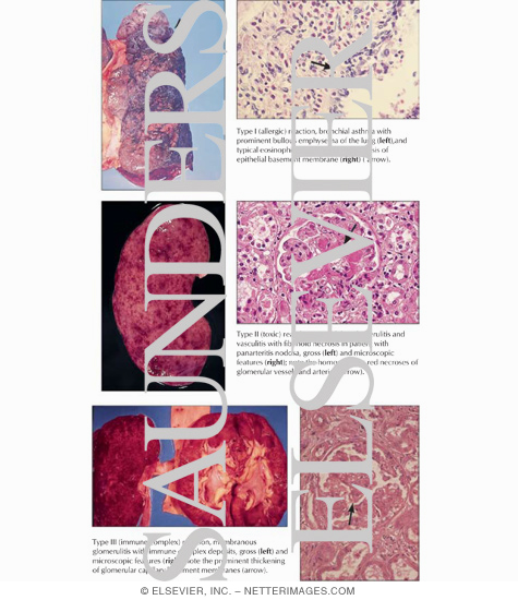 Watermarked preview of labeled image: Immunologic Inflammation: B Cell