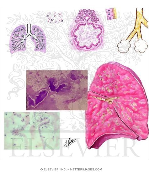 Watermarked preview of unlabeled image: Pathogenesis of Cystic Fibrosis