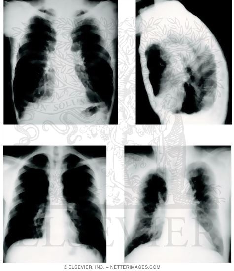Watermarked preview of unlabeled image: Emphysema