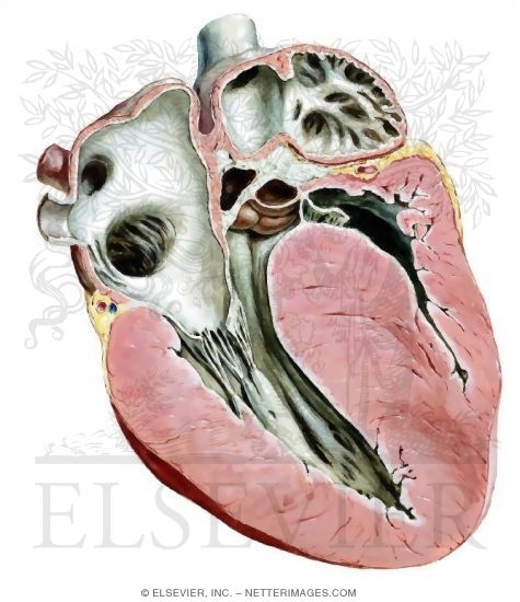 Idiopathic Hypertrophic Subaortic Stenosis: Hypertrophic Cardiomyopathy