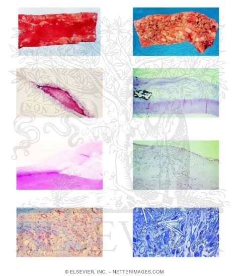 Atherosclerosis