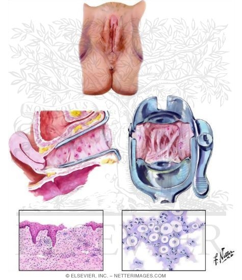 Vaginal Atrophy