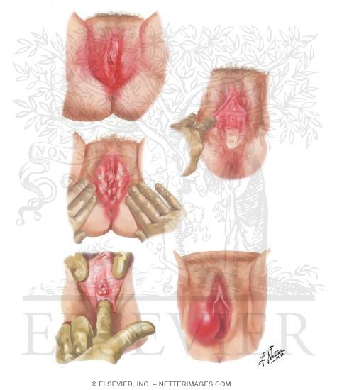 Diabetic Vulvitis, Trichomoniasis, Moniliasis, and Gonorrhea