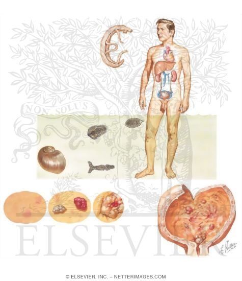Urinary Schistosomiasis