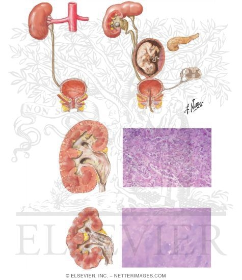 Watermarked preview of unlabeled image: Pyelonephritis