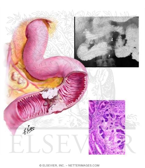 Cancer of the Small Intestine: Adenocarcinomas