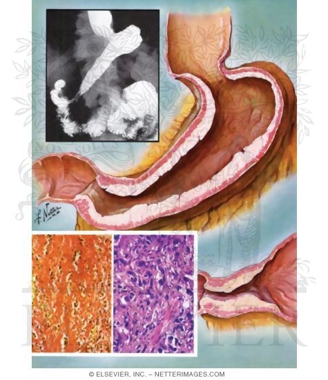 Watermarked preview of unlabeled image: Carcinomas of the Stomach