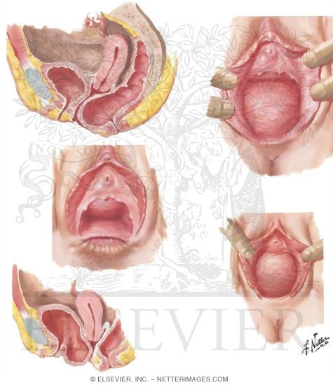 Watermarked preview of unlabeled image: Cystocele and Rectocele