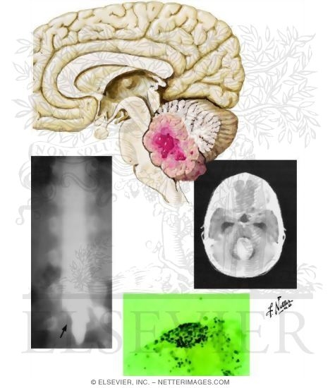 Watermarked preview of unlabeled image: Brain Tumors In Children