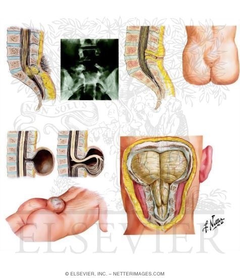 Watermarked preview of unlabeled image: Spinal Dysraphism
