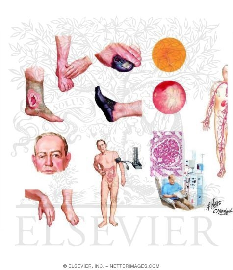 Watermarked preview of unlabeled image: Non - Insulin - Dependent Diabetes Mellitus