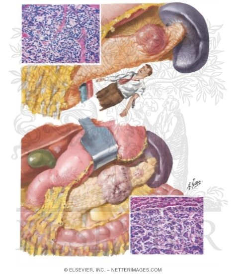 Insulinoma