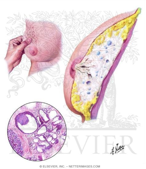 Fibrocystic Disese: Adenosis