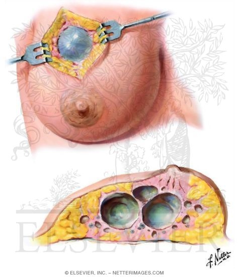 Fibrocystic Disease: Cystic Changes
